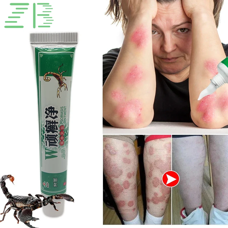 

Мазь китайская при псориазе экземе, 20 г