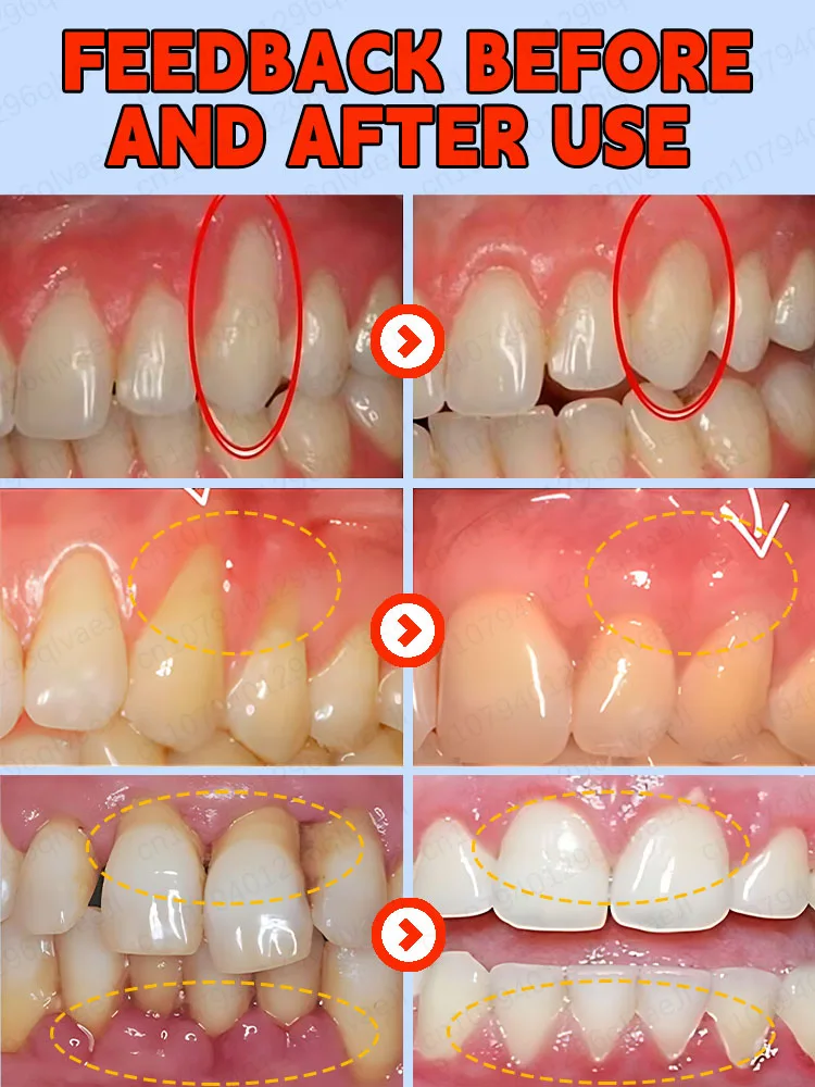 Tooth restoration gum strengthening healthy teeth dental mirror