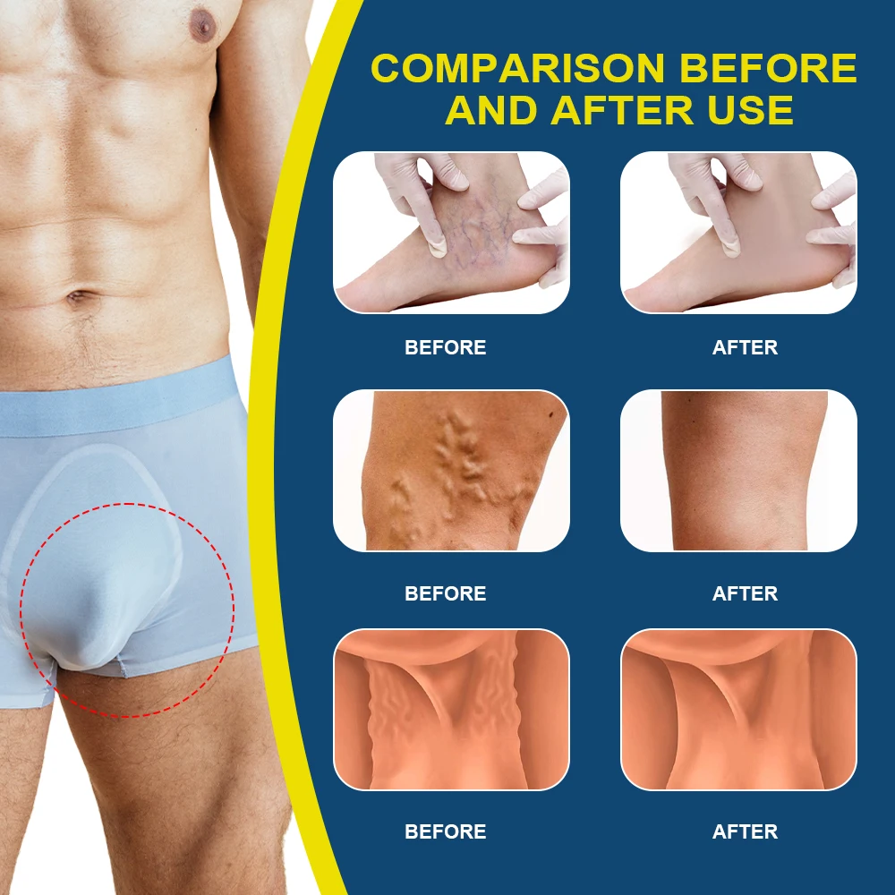 Pain Relief Cream Sumifun Varicocele Varicose Vein Cream Phlebitis Vasculitis Ointment Varicosity Angiitis Medical Health Care Plaster