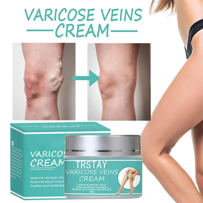 Varicose Veins Relief Cream Body Leg Vasculitis Phlebitis Spider Pain