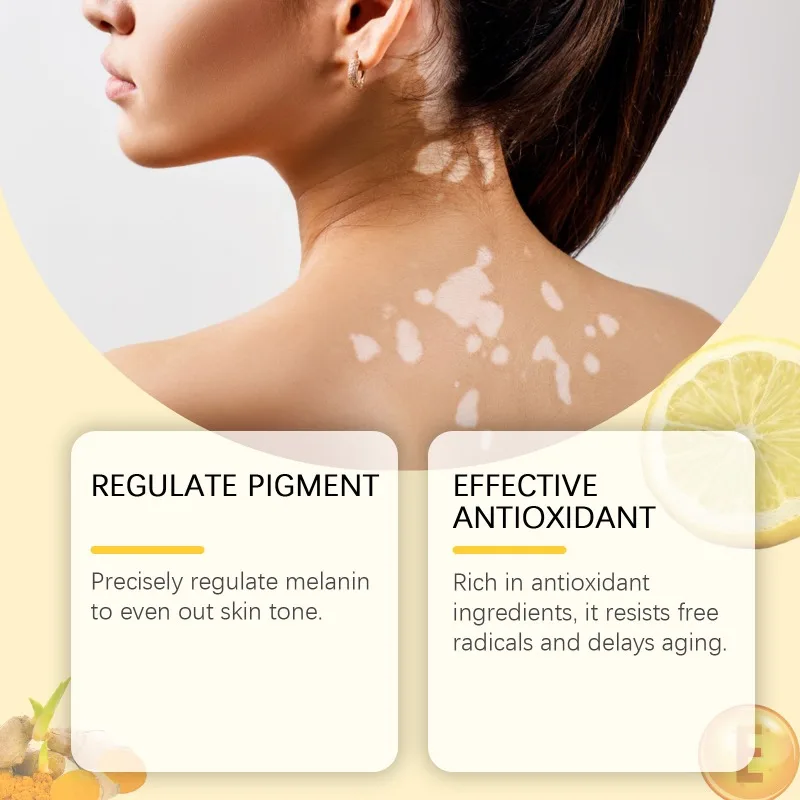Bee Venom Vitiligo Treatment Cream Eliminate Vitiligo Sweat Spot Antibacterial Mycosis Leukoplakia Cure Moisturizes Care Cream vitiligo ointment