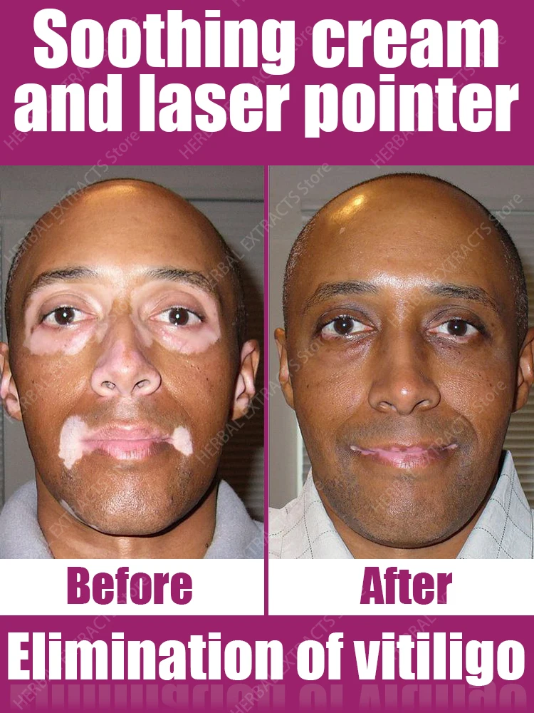 Vitiligo laser treatment pen for men and women