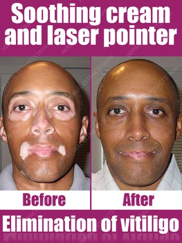 Vitiligo laser treatment pen for men and women