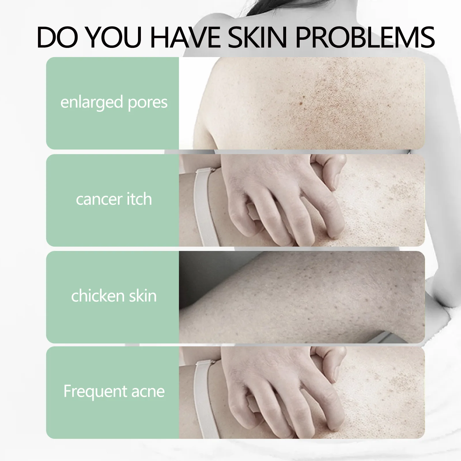 Chicken Skin Repair Cream Curing Body Keratosis Pilaris Remove Acne Spots Rough Bumpy Pores Moisturizing Smooth Whitening Lotion 5