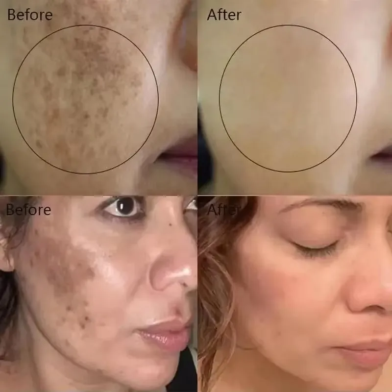 Vitamin C Whitening Serum Remove Freckles Dark Spots Face Essence Fade Melasma Melanin Brighten Repair Dull Skin Care Cosmetics 2