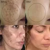 Vitamin C Whitening Serum Remove Freckles Dark Spots Face Essence Fade Melasma Melanin Brighten Repair Dull Skin Care Cosmetics 2
