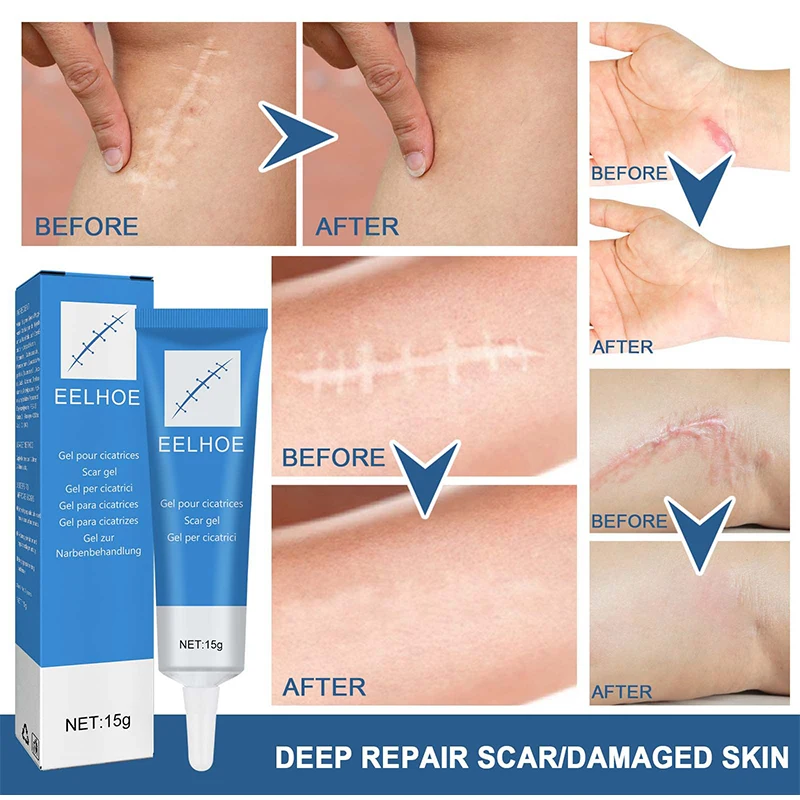 Eelhoe Scar Repair Gel, Cold Compress, Skin Damage Repair Softening Cream, Soothes Scars Moisturizes Laser Therapy Keloid Scar