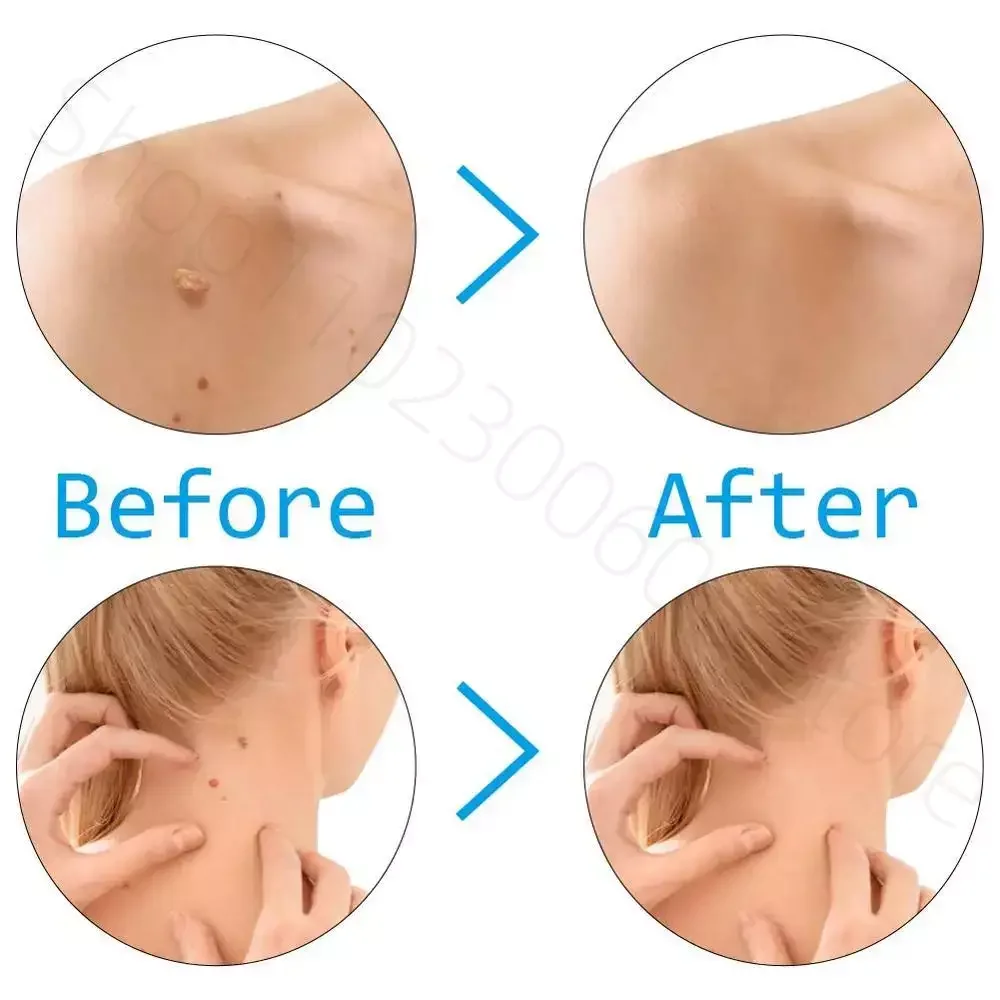 2In1 Painless Skin Tag Removal Kit Mole Wart Remover Micro Skin Tag Treatment Removal Meat Nevus Corns Warts Care Tools