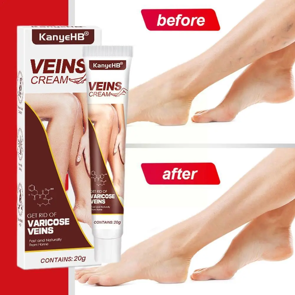 

Effective Varicose Vein Relief Cream Ointment For Varicose Veins To Relieve Vasculitis Phlebitis Spider Pain Treatment Y0S4