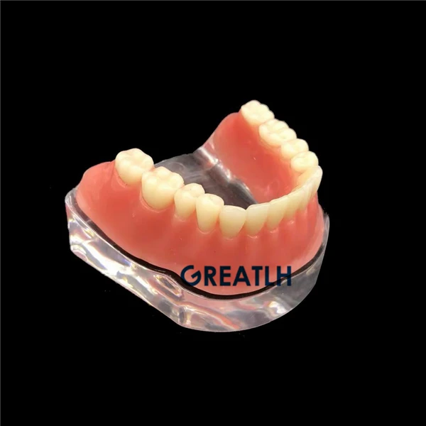 Overdenture implant model Denture Teeth mandibular model with golden