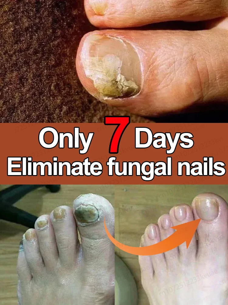 Foot serum withonychomycosis essential oil 7-day repair organic essential oil