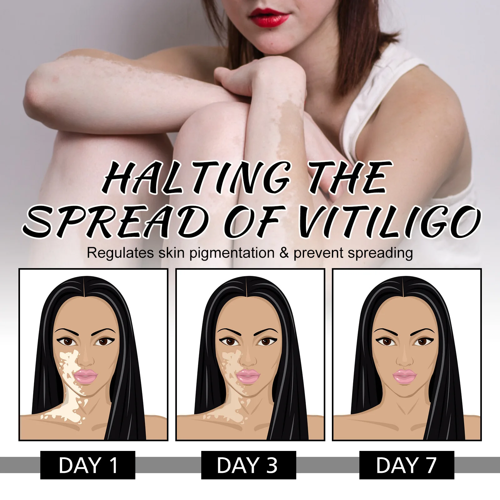Spray traitement vitiligo élimination taches blanches soin peau_voghion.com