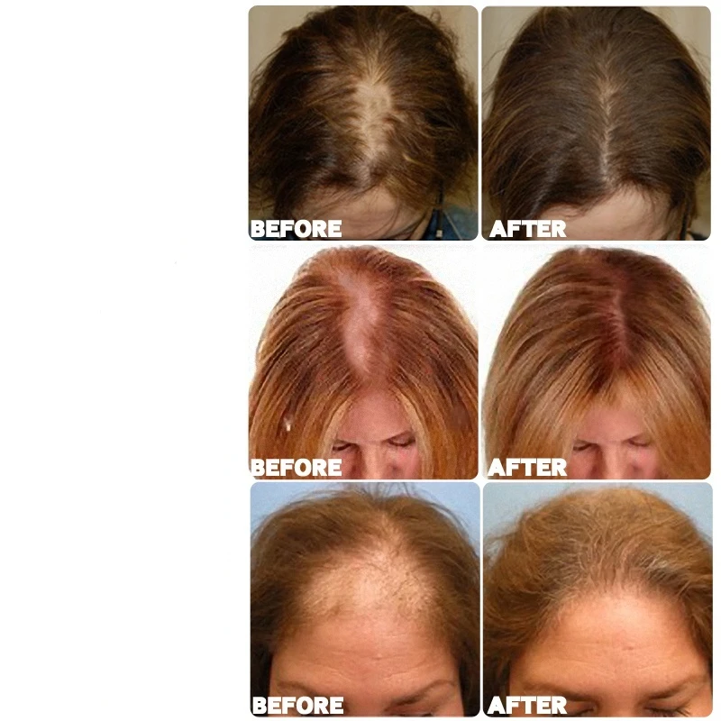 TRSTAY Hair Growth Spray Ginger Hair Grow olejek eteryczny do włosów leczenie zapobieganie utrata włosów Spray do włosów