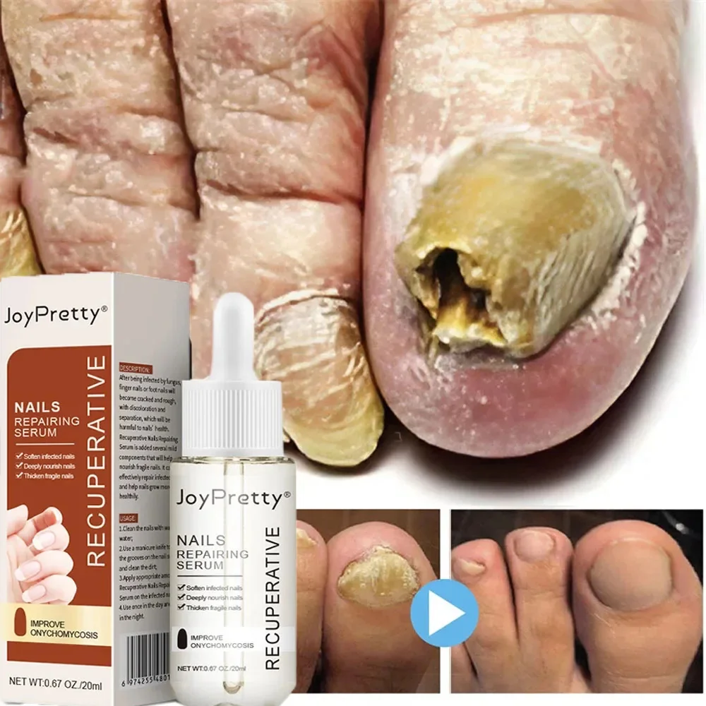 

Nail Fungus Treatment Serum Foot Repair Liquid Toe Nails Fungal Removal Gel Anti Infection Paronychia Onychomycosis Foot Care