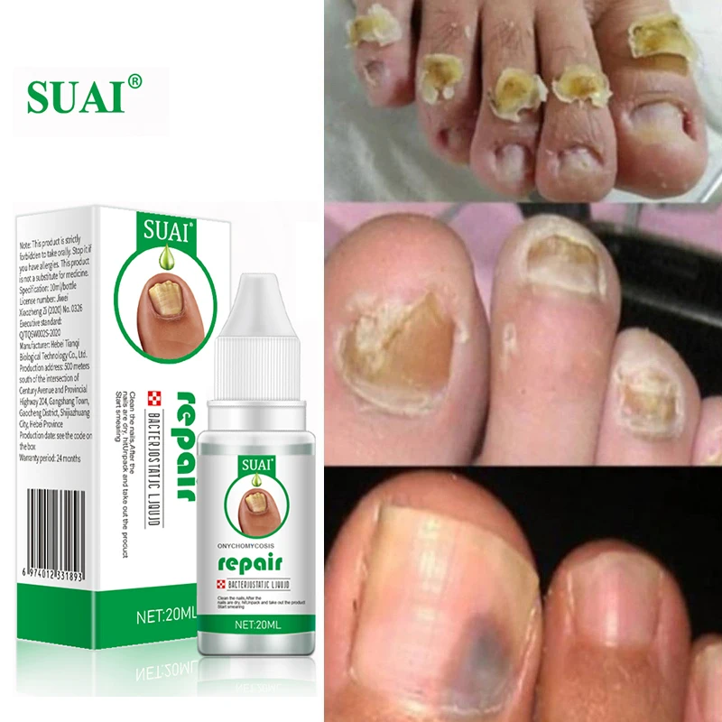 

Instant Nail Fungal Treatment Essence Anti Infection Toe Nail Repair Gel Paronychia Onychomycosis Nourishing Foot Care Products