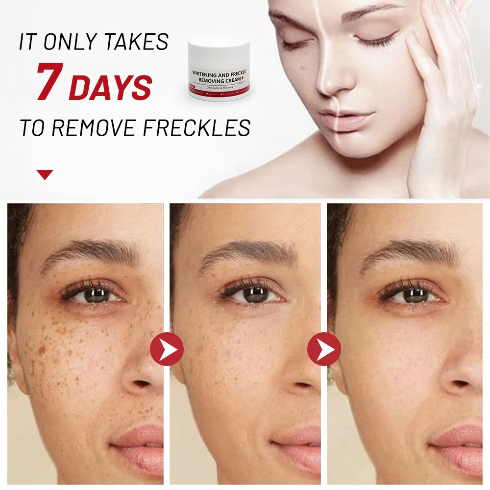 Whitening Cream 7-day rapid freckle removal