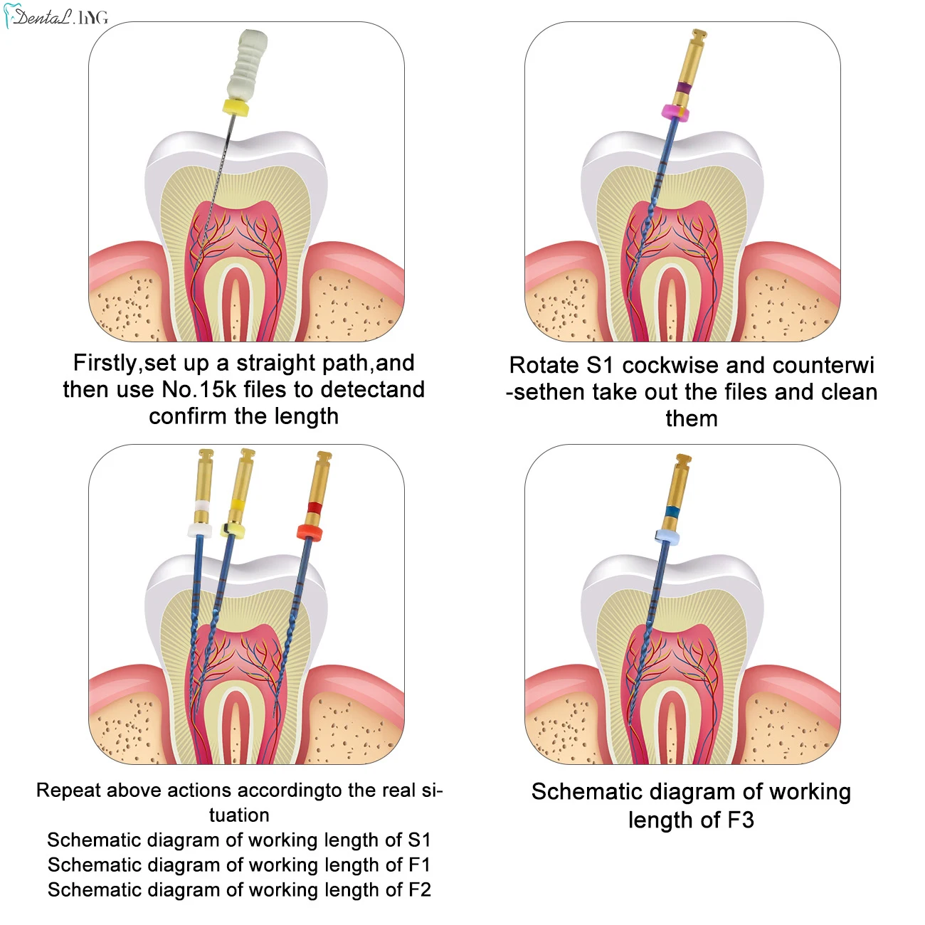 Premium Gold Endodontic Rotary Files - Nickel Titanium Dental Instrument