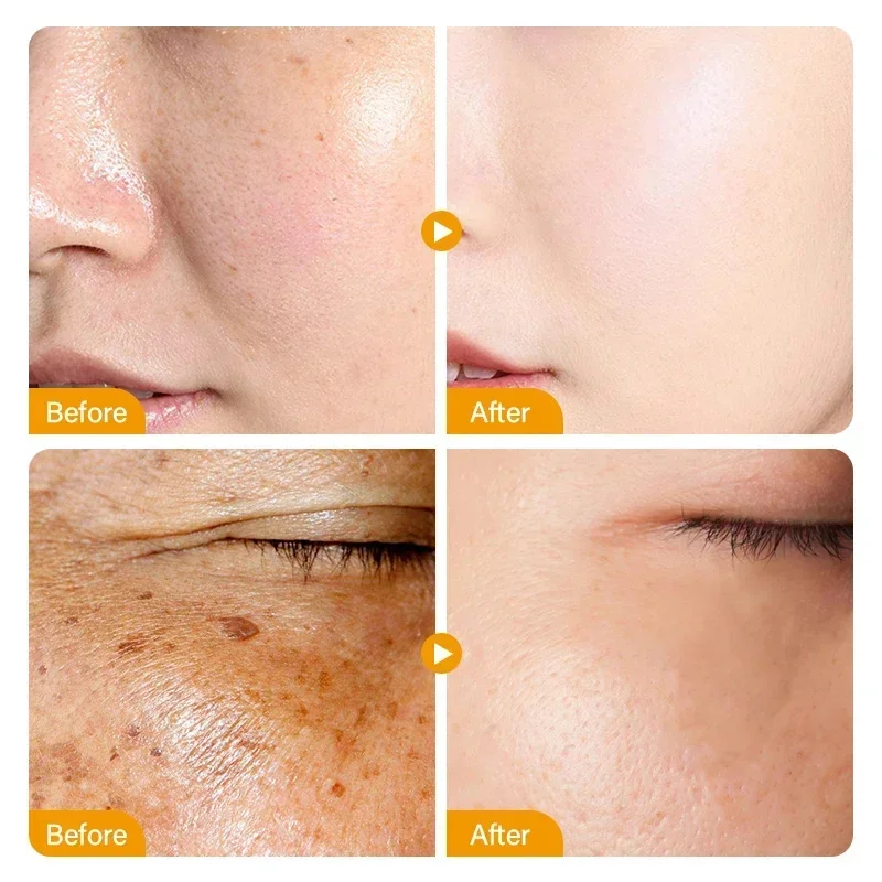 Dark Spots Remover Whitening Face Set Freckle Melanin Correcting Reduce Fine Lines Brighten Essence Korean Beauty Skin Care