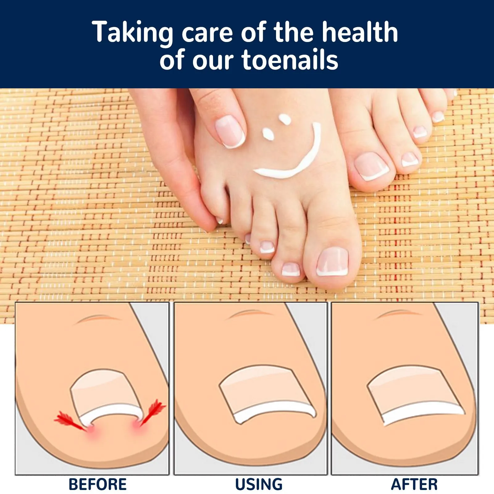Ingrown Toenail Corrector Sticker 100Pcs Foot Care Pedicure Foot Orthodontic Toe Thumb Nail Care Patches,ingrown toenail correction tool,manicure pedicure tool set,foot care tool,foot pedicure tool,foot care patches,toe corrector,nail problem solving