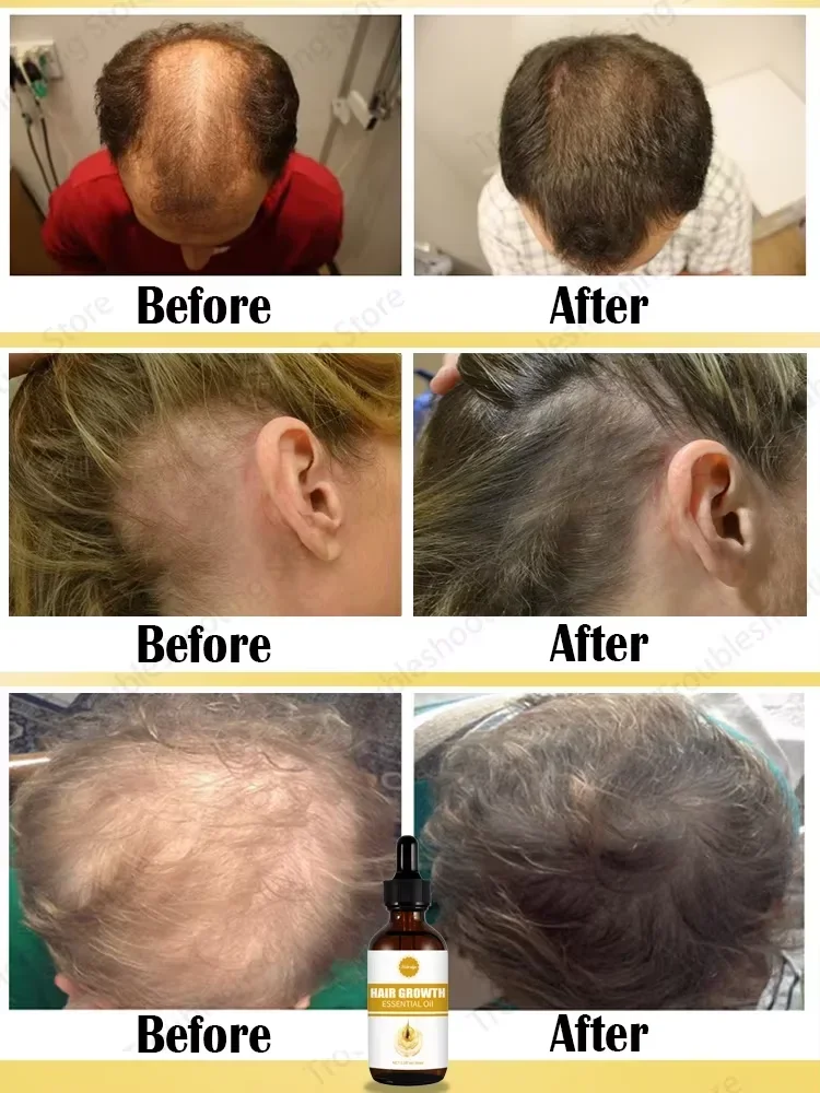 Óleos essenciais que promovem o rápido crescimento do cabelo e tratam a calvície e a queda de cabelo 4