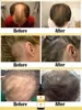 Óleos essenciais que promovem o rápido crescimento do cabelo e tratam a calvície e a queda de cabelo 4