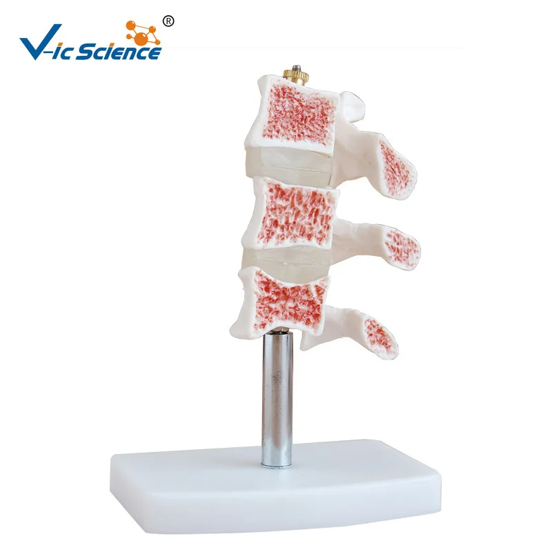 Life Szie Anatomical Human Cutaway Osteoporosis