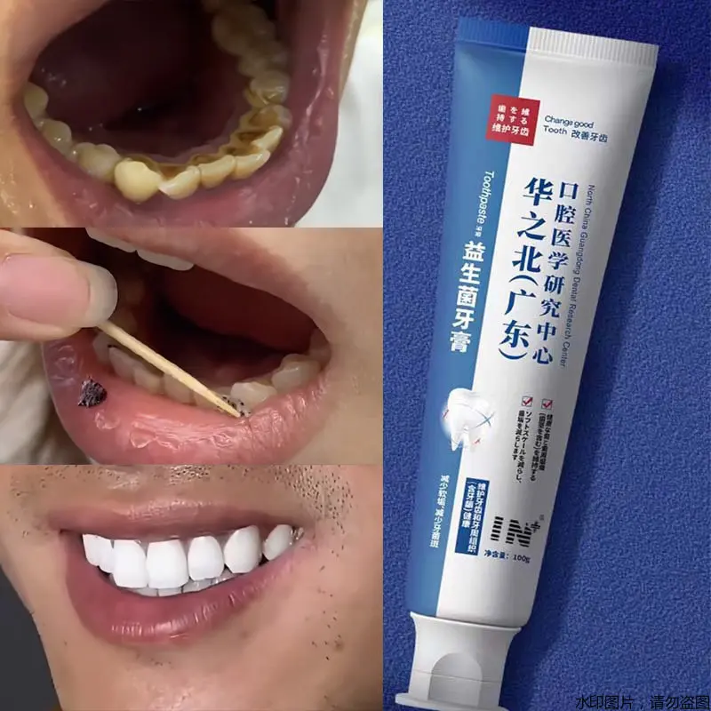 

Sdotter Quick Repair of Cavities, Caries, Filling, Removal of Plaque, Stains, Decay Whitening Yellowing Repair Teeth Teeth White