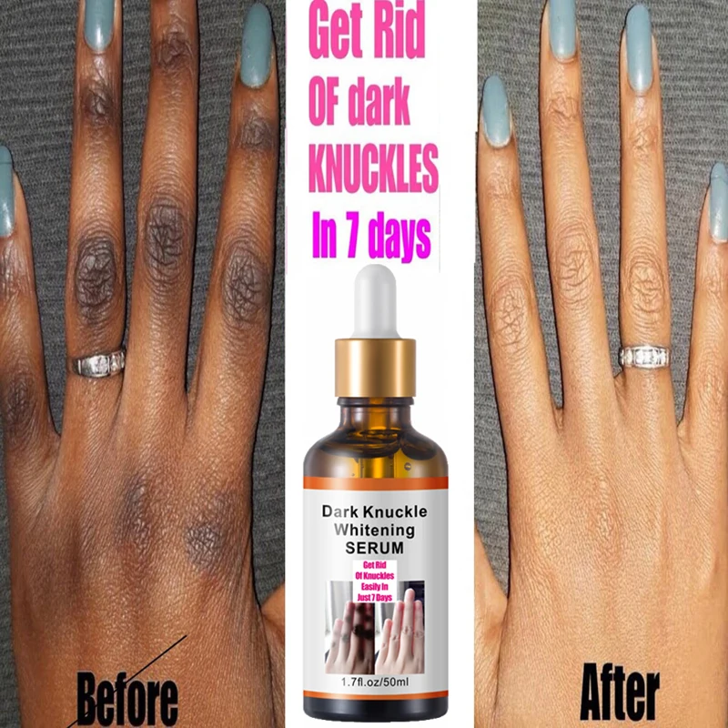 Get Rid Of Dark Knuckles In 7 Days Serum Whitening Removing Dark knuckles Serum Hand knuckle Eraser Serum for Elbow and Knee