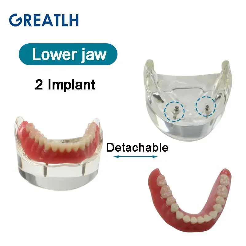 Dental Teeth Model with Implant Overdenture Inferior Demo Mandibular Model Dentist Student Learning Model 3