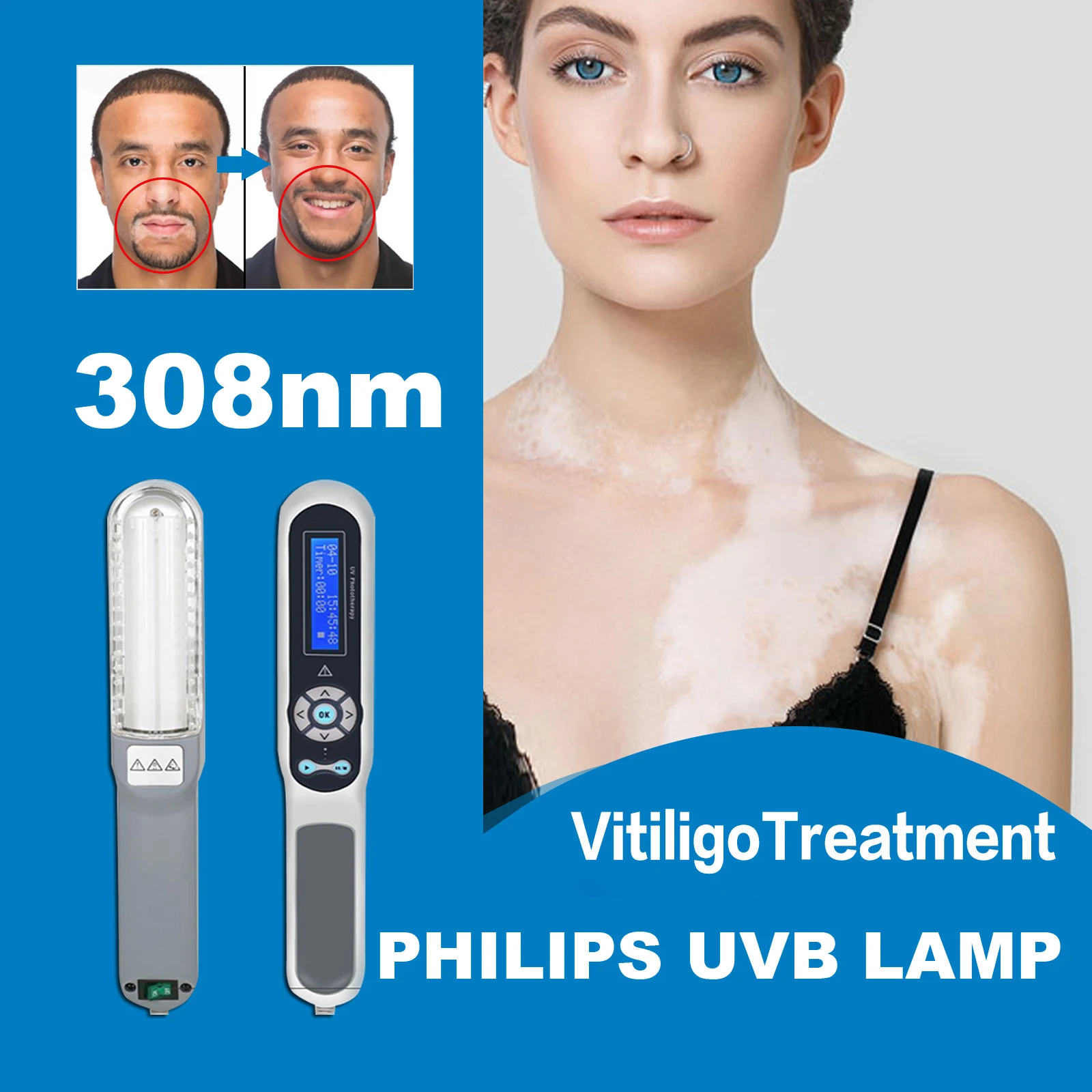 311nm UVB Ultraviolet Phototherapy Light Instrument for Vitiligo Psoriasis Skin Treatment and Therapy Treatment Lamp