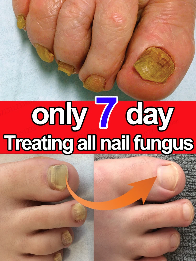 Fungus Solution 7 jours de r&eacute;paration d'huile d'essence d'ongle produits de soins pour l'onychomycose