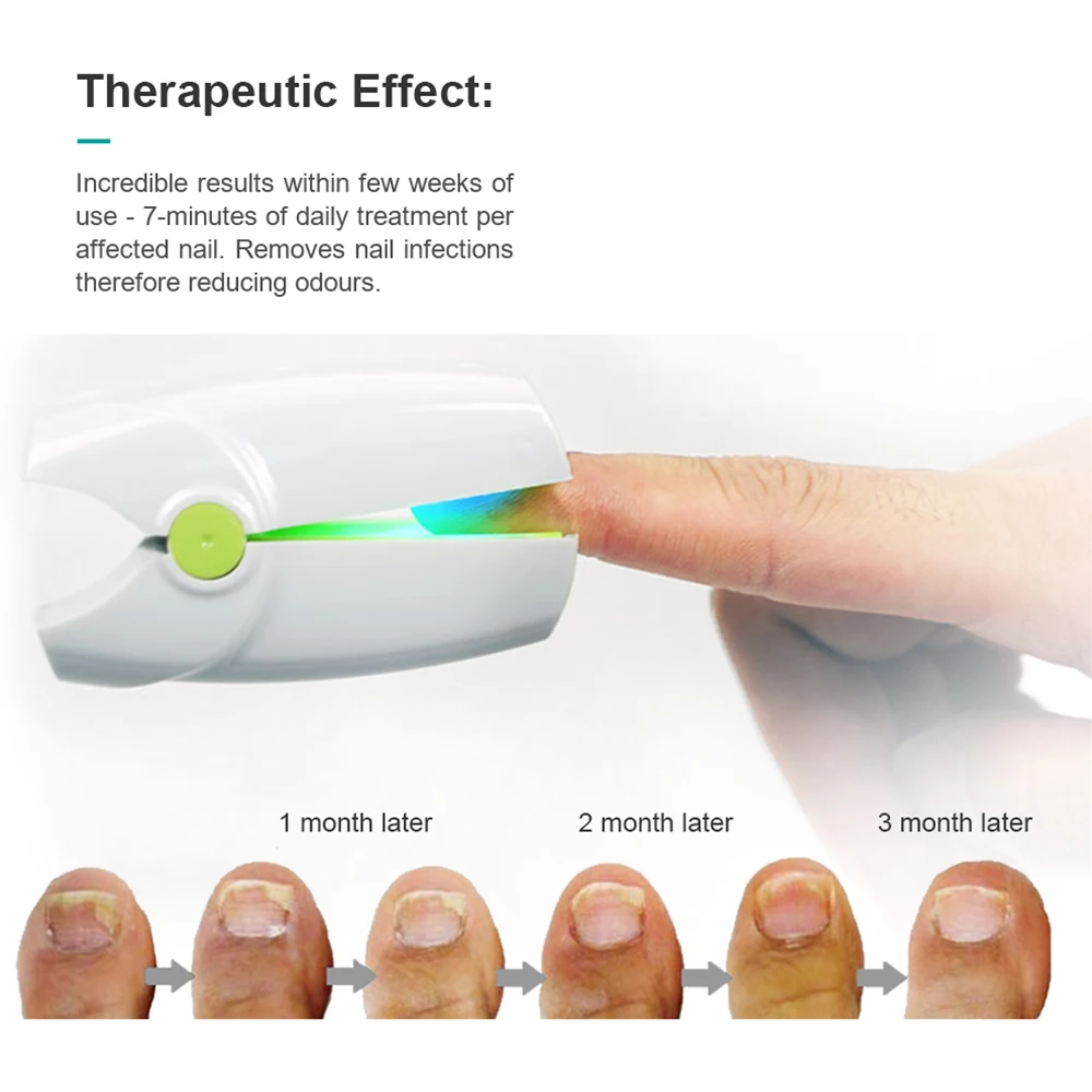 

Onychomycosis Treatment Infrared Laser Nail Fungus Laser Therapy LED Light Nail Removal Prevent Fungal Infection Foot Care Tools