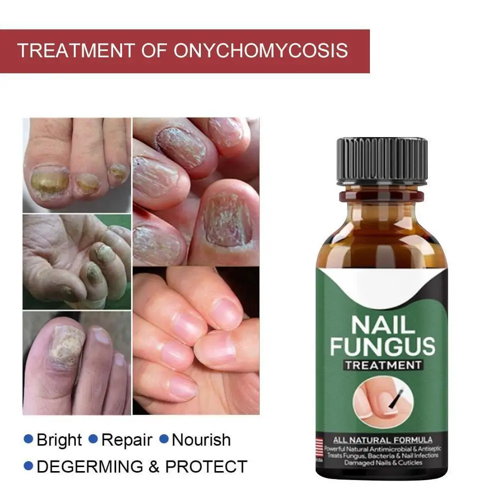 

50ml Grey Nail Care Repair Essence Liquid Paronychia Anti Fungal Toe Care Anti Infection Foot Care Productions