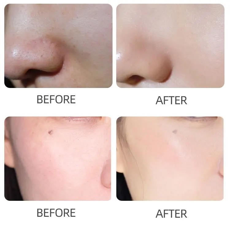 Рисунок 3 - Беспроводная электрическая нано-микроигла