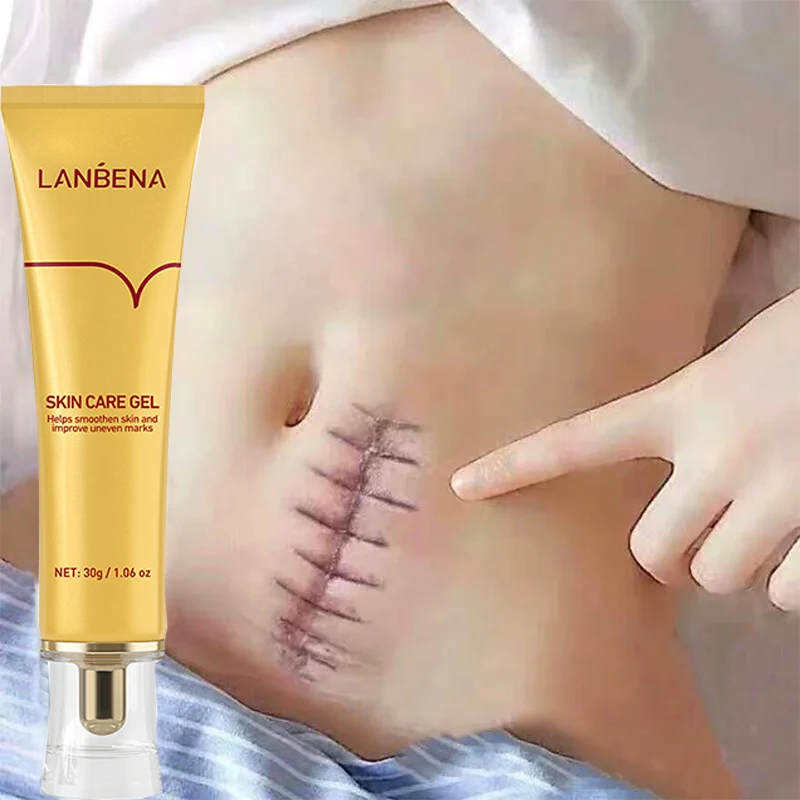 

LANBENA Scar Removal Cream Effective Treatment Stretch Marks Burn Fade Acne Spots Repair Gel Whitening Smoothing Body Skin Care