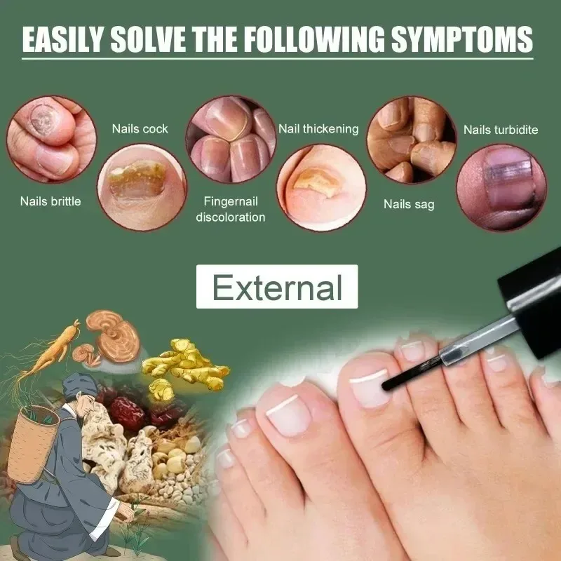 Nail Fungal Treatment Essence Oil Foot Toe Nail Fungus Removal Serum 7 Days Repair Onychomycosi Anti Infection Gel