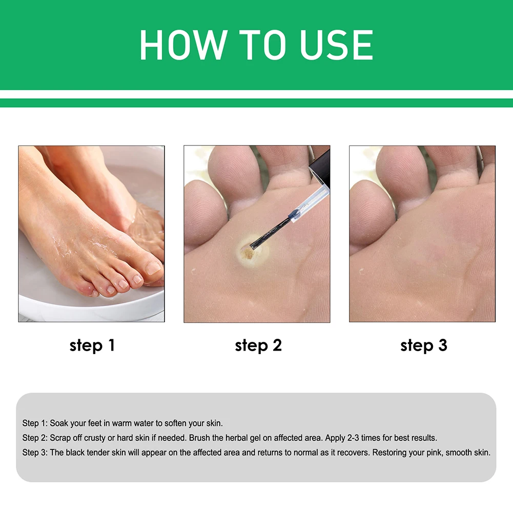 10/20ml Foot Care Corn Removal Extra Strengthen Gel Liquid To Smooth Skin Remove  Warts Corns Callosity Detox Foot Tag Remover| | - AliExpress