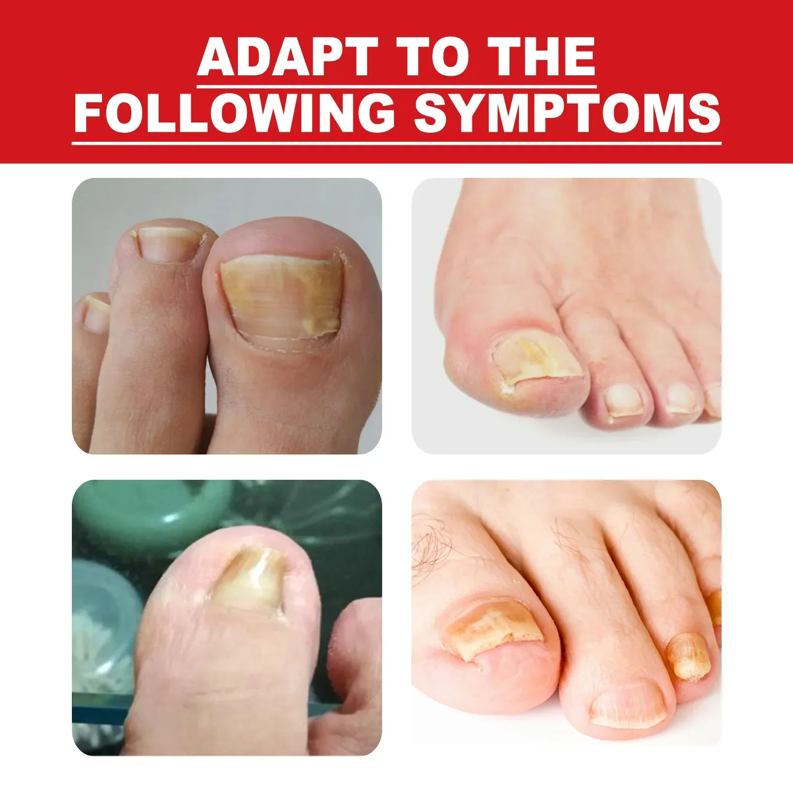 Nail Treatment Essence for Ingrown Toenail Fungus Repair