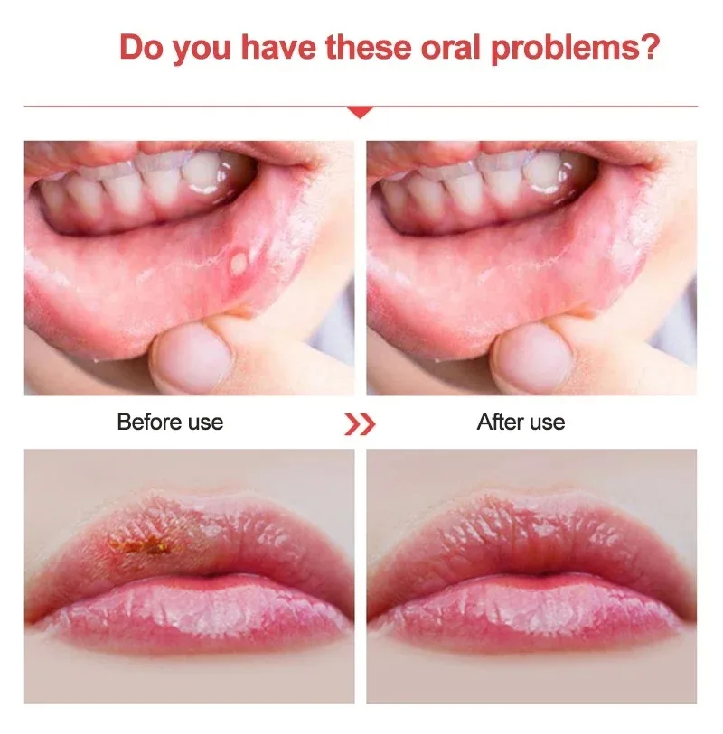 Red Light Therapy Cold Sore Device For Mouth Sores Treatment 660nm 850nm NearInfrared LED Light Therapy Machine Skin Care Wand