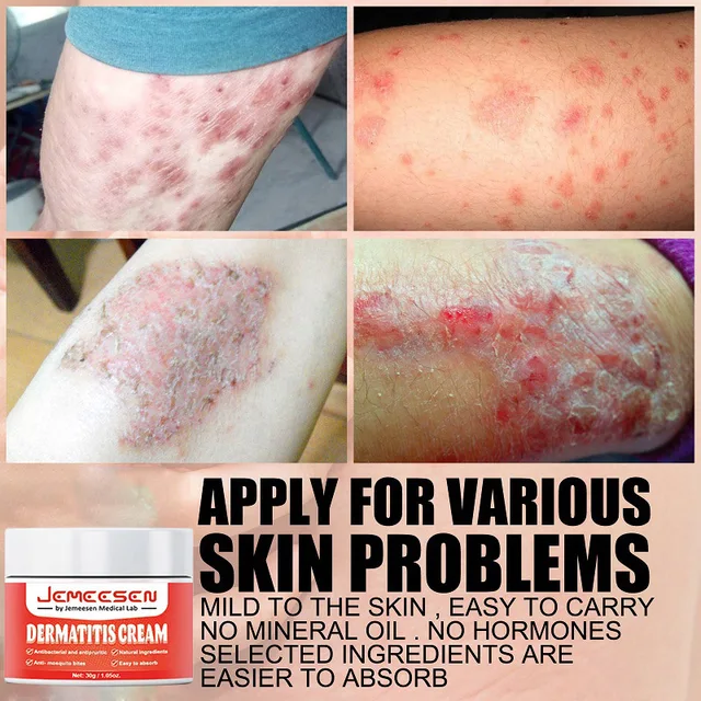 Psoriasis Antibakteriális Krém Dermatitis Ekzematoid Hatékony - Image 5