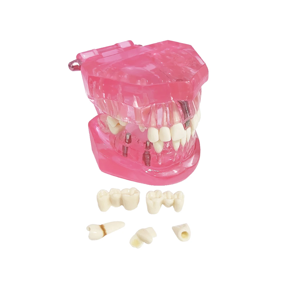 Dental Restoration & Disease Analysis Teaching Model