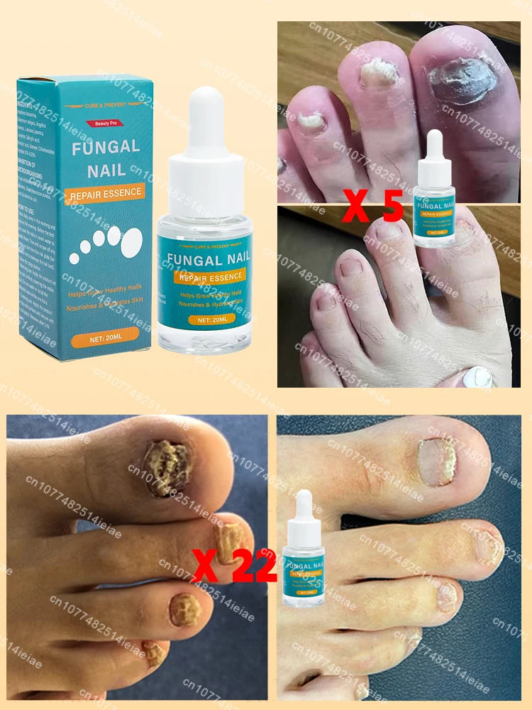 Nail fungus treatment essential oil repair onychomycosis in 7 days