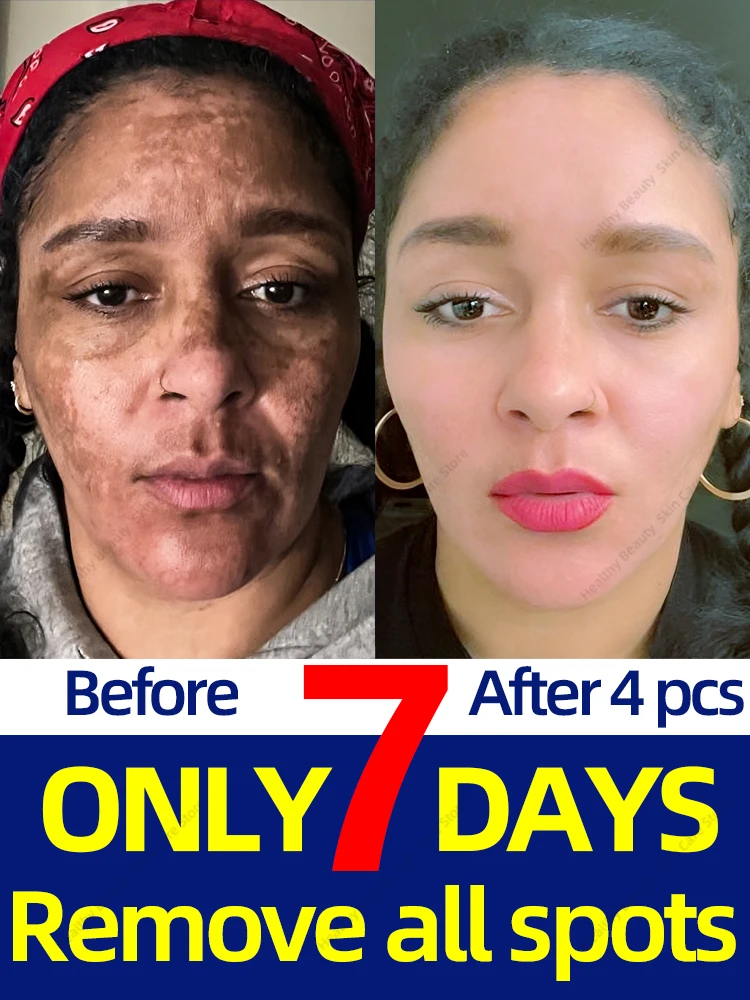 

Freckles Cream Dark Spots