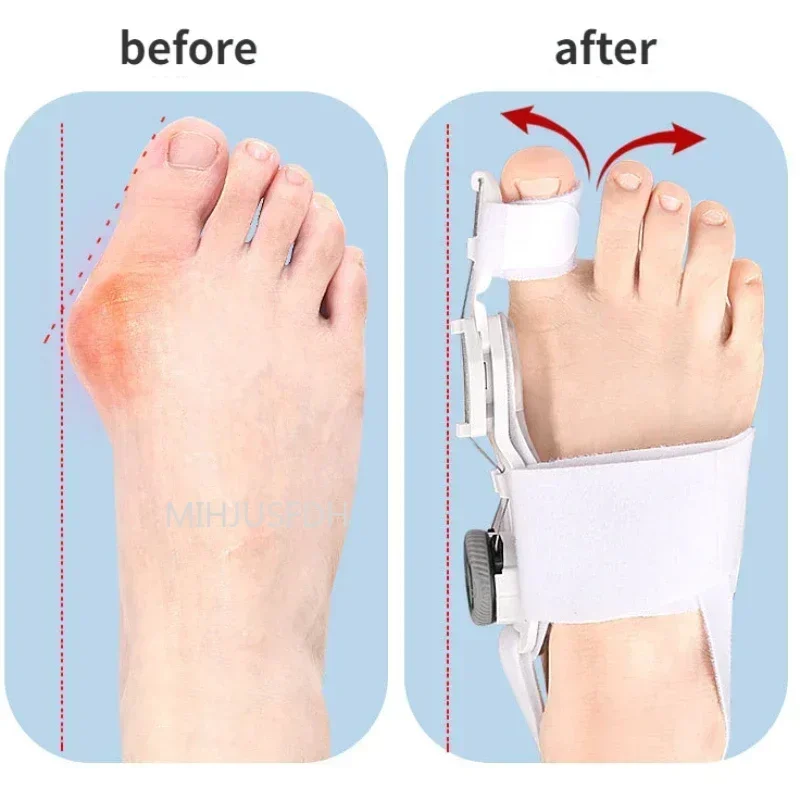 Adjustable Toe Corrector Unisex Bunion Foot Hallux Valgus Braces Rotatable Toe Separator Straightener for Left and Right Foot