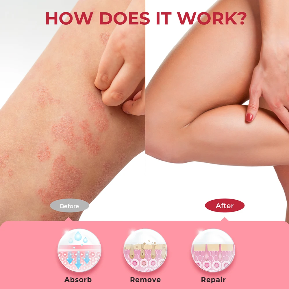 Sumifun Eczema Ointment 1Box 20g Treat Urticaria Seborrheic Dermatitis Psoriasis Antibacterial Cream Skin Itching Medical Paste