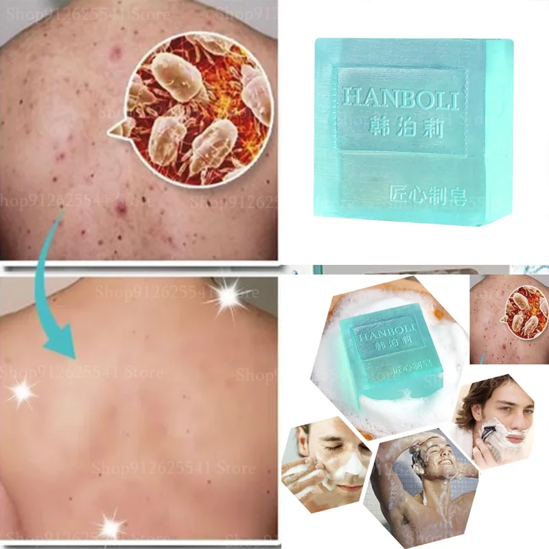 Acne Treatment Blackhead Mites Dirt Removal Soap for Women Men Handmade
