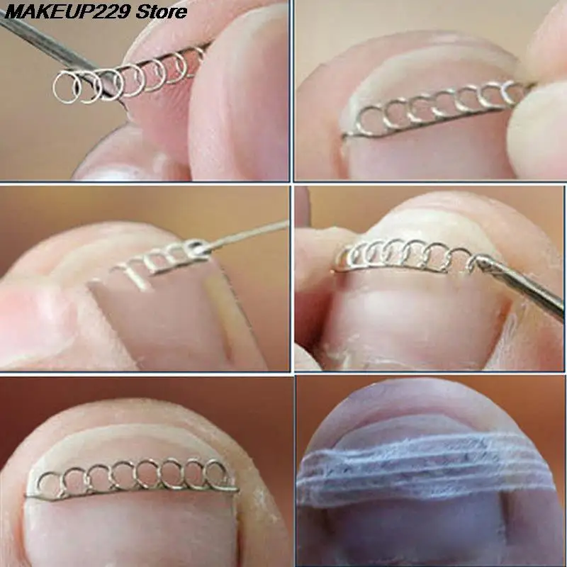Ingrown Toe Nail Correction Wire Fixer Pedicure Paronychia Recover Toenails Corrector Foot Care Tool 12pcs ingrown toenail correction tool manicure pedicure tool set foot care tool foot pedicure tool toe corrector