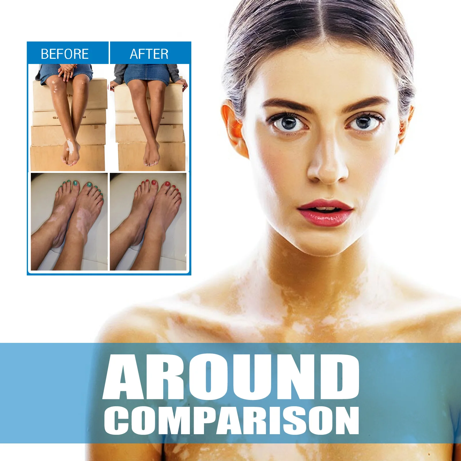 South Moon Vitiligo Treatment Ointment Antibacterial Remove White Spot Ringworm Skin Leukoplakia Disease Dermatitis Cream 20ml