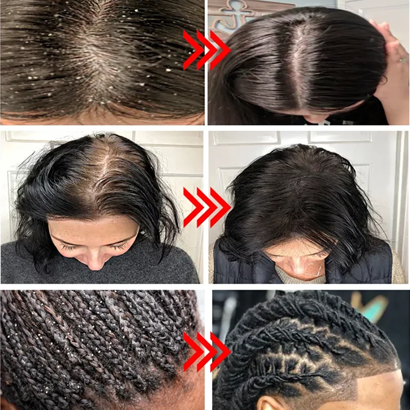 Hair Shampoo Anti-Dandruff Anti-Itch Shampoo Fast Cleaning Repair Scalp Treatment Products Oil Control Antibacterial Mite Hair Care Men Women