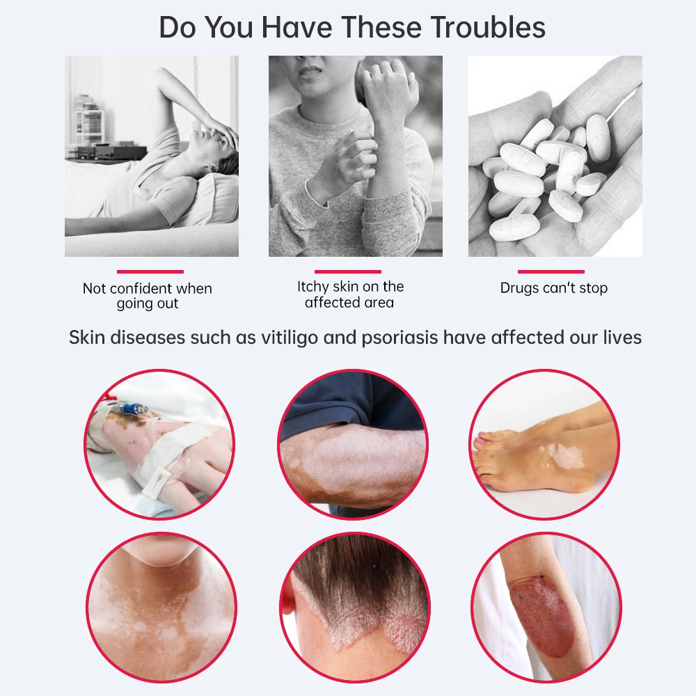 311nm UvB Light Phototherapy for Vitiligo Skin Problems Treatment Ultraviolet Lamp Adopt Medical Light Source Treat Psoriasis - Image 2